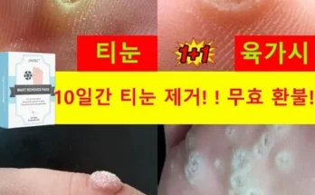 정말 놓치기 아까운 티눈밴드 지금 구매하세요