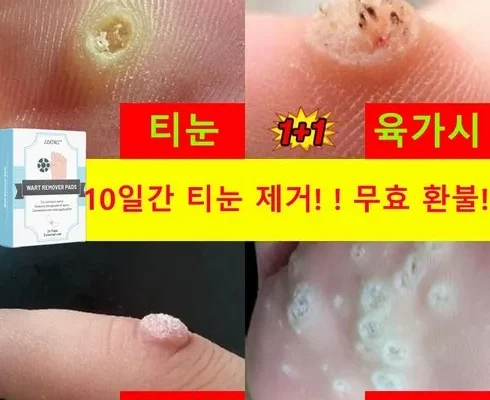 정말 놓치기 아까운 티눈밴드 지금 구매하세요